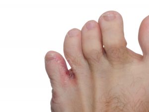AdobeStock 45042844 300x225 - Fungal Nail Care, Athlete's Foot Care and Treatment